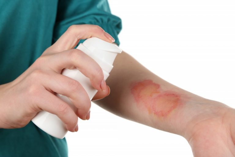 Burns and Scalding
